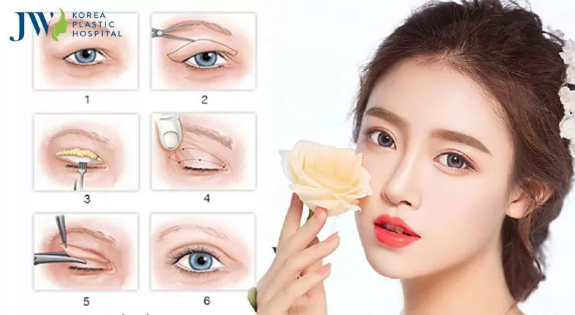 Cắt mí mắt cải thiện tướng số theo hướng tích cực