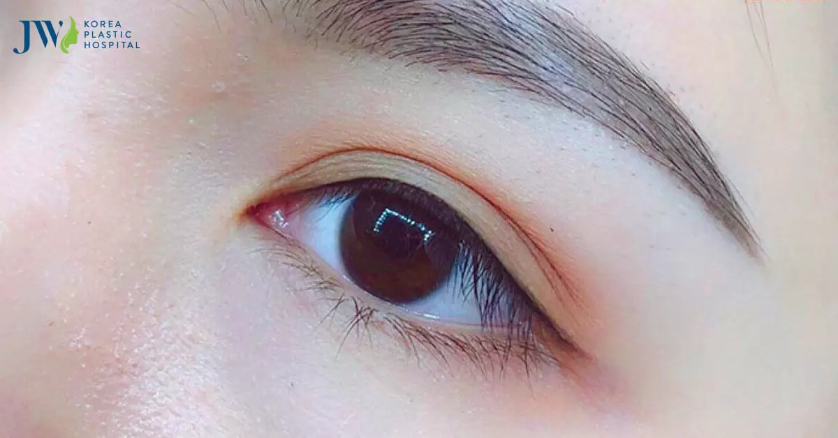 Lấy mỡ bọng mắt giá bao nhiêu? Thực hiện ở đâu an toàn hiệu quả?