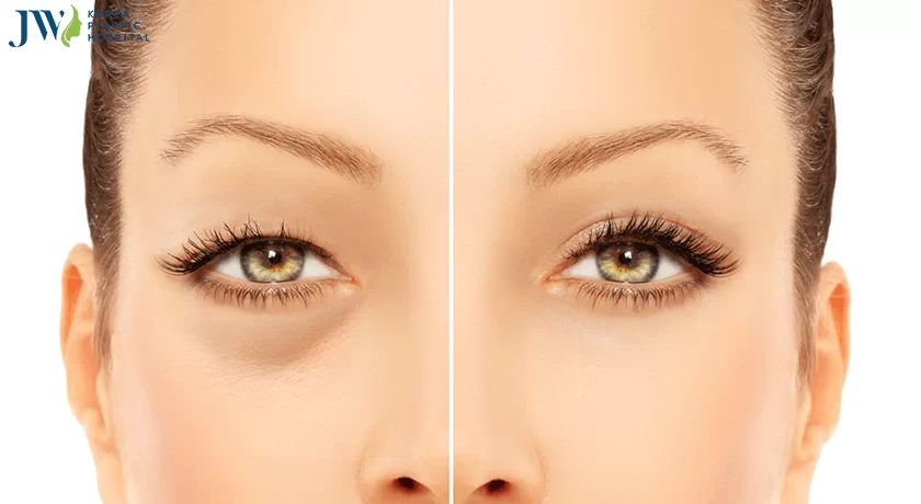 Cách chăm sóc sau khi lấy mỡ bọng mắt nội soi