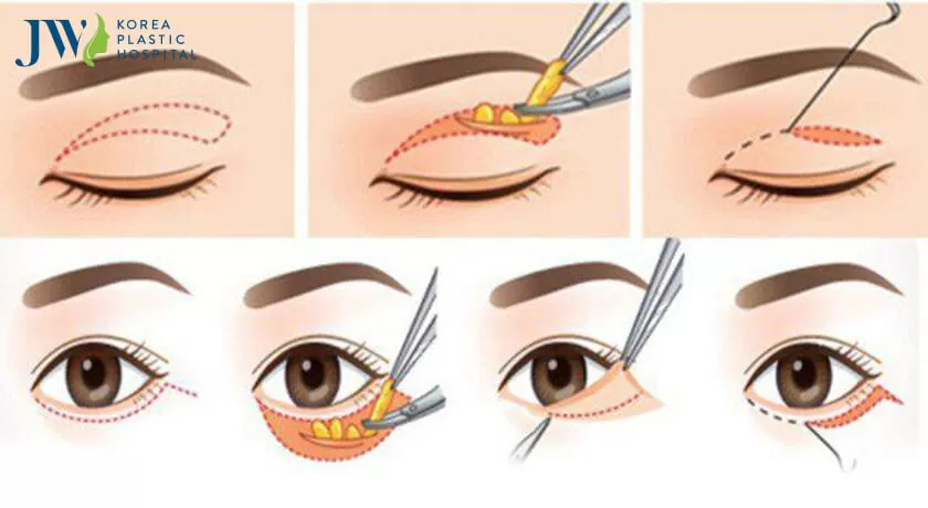 Mô phỏng lấy mỡ mắt.