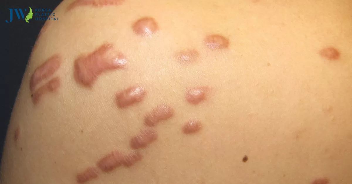 Sẹo lồi ở ngực nguyên nhân và phương pháp điều trị hiệu quả