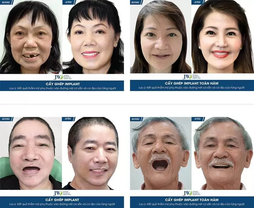 Trồng răng Implant