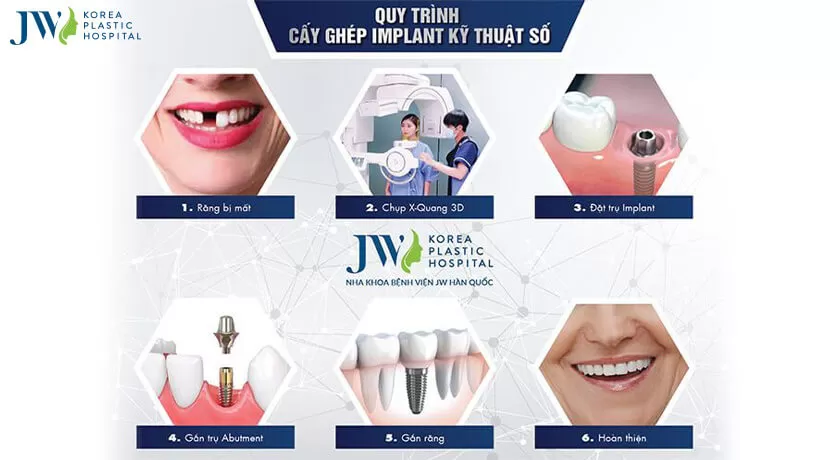 Trồng răng Implant
