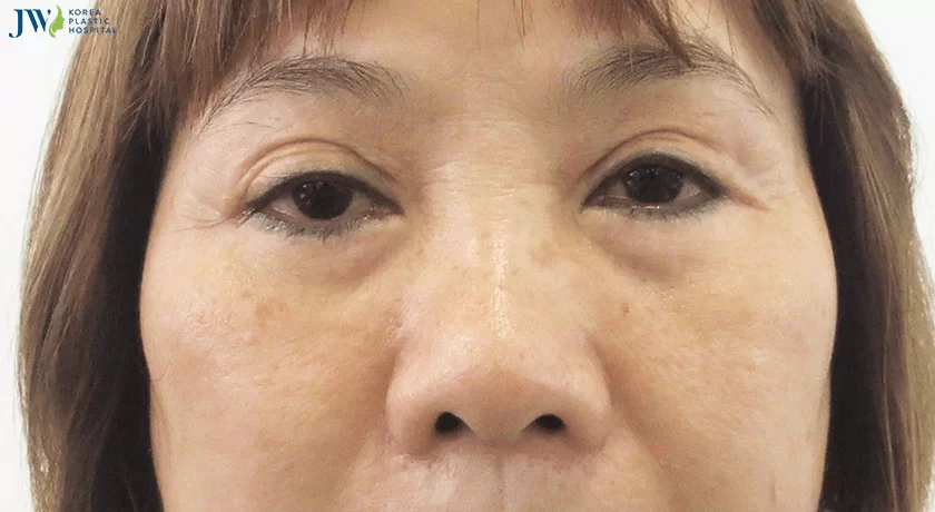 Mắt buồn là gì