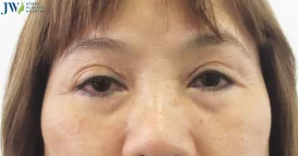 Mắt buồn là gì