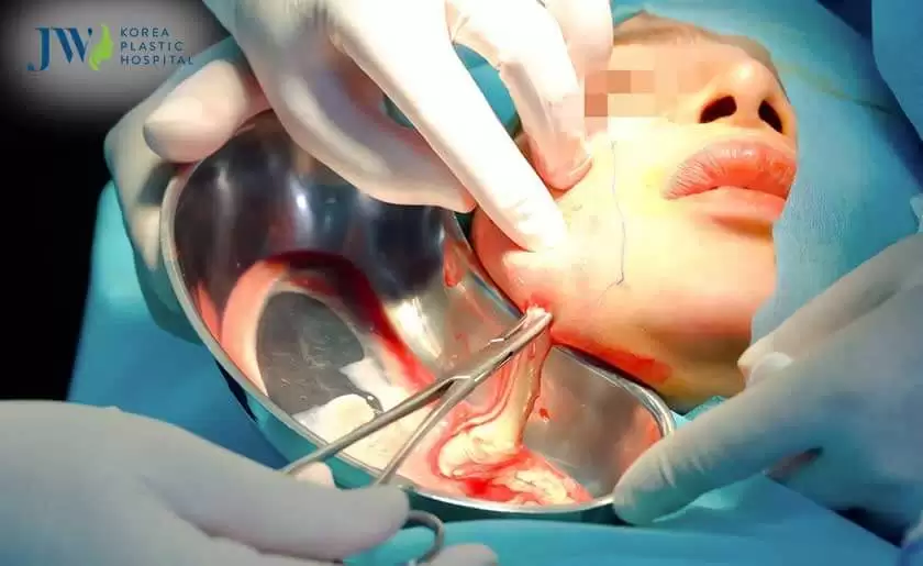 Thẩm mỹ chui và những ca biến chứng