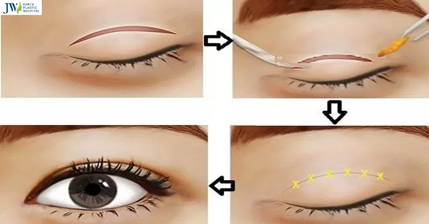 cắt da thừa mí mắt 