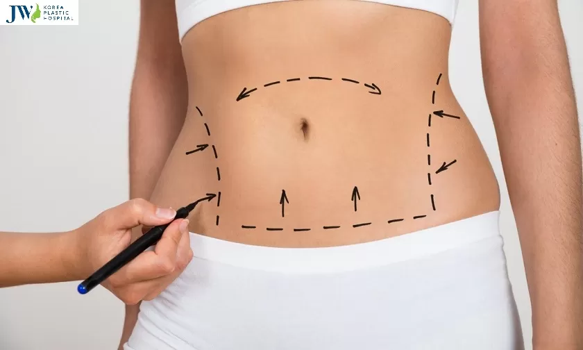 hút mỡ bụng có bị béo lại không
