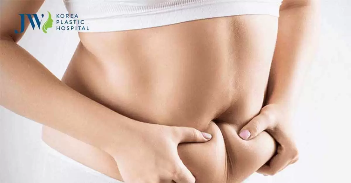 Hút mỡ bụng ở đâu an toàn, uy tín và cách chăm sóc đúng chuẩn