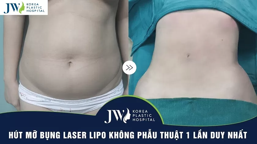 Kinh nghiệm hút mỡ bụng Kỹ thuật hút mỡ vượt trội tại JW