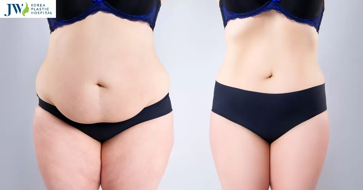 Kinh nghiệm hút mỡ bụng an toàn hiệu quả từ chuyên gia