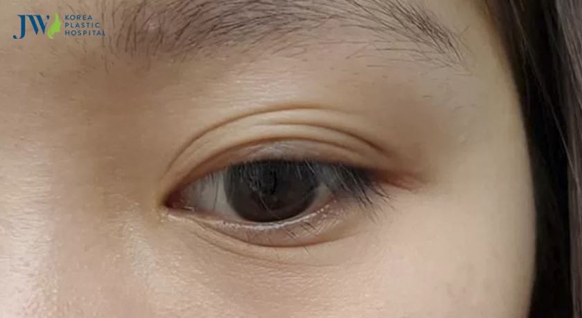 Mắt 1 mí rưỡi