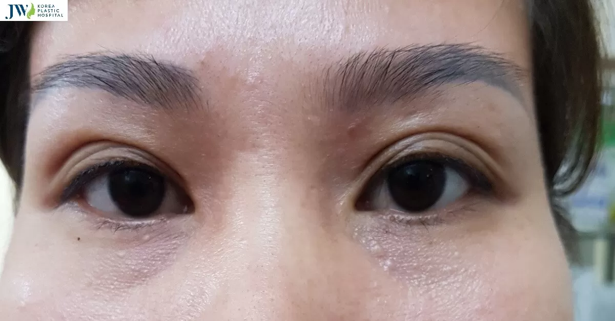 Đôi mắt 3 mí là gì mà chị em nào cũng than thở