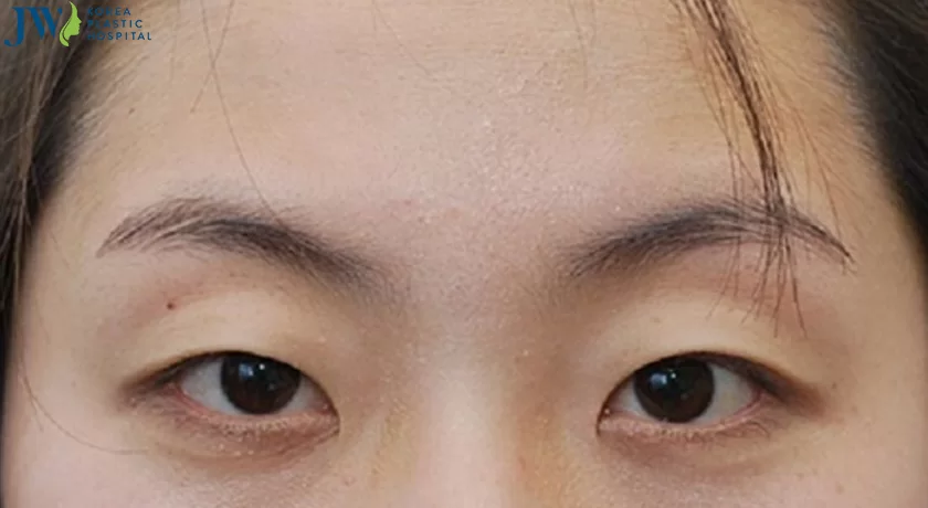 mắt cụp