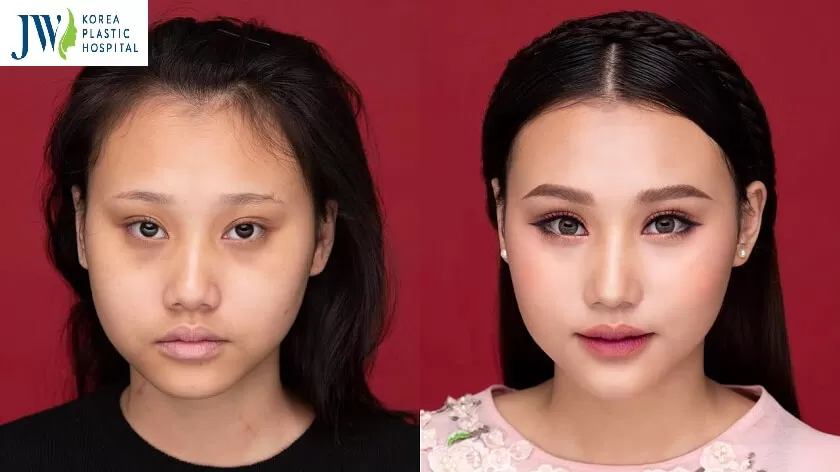 Mắt lá khoai là gì