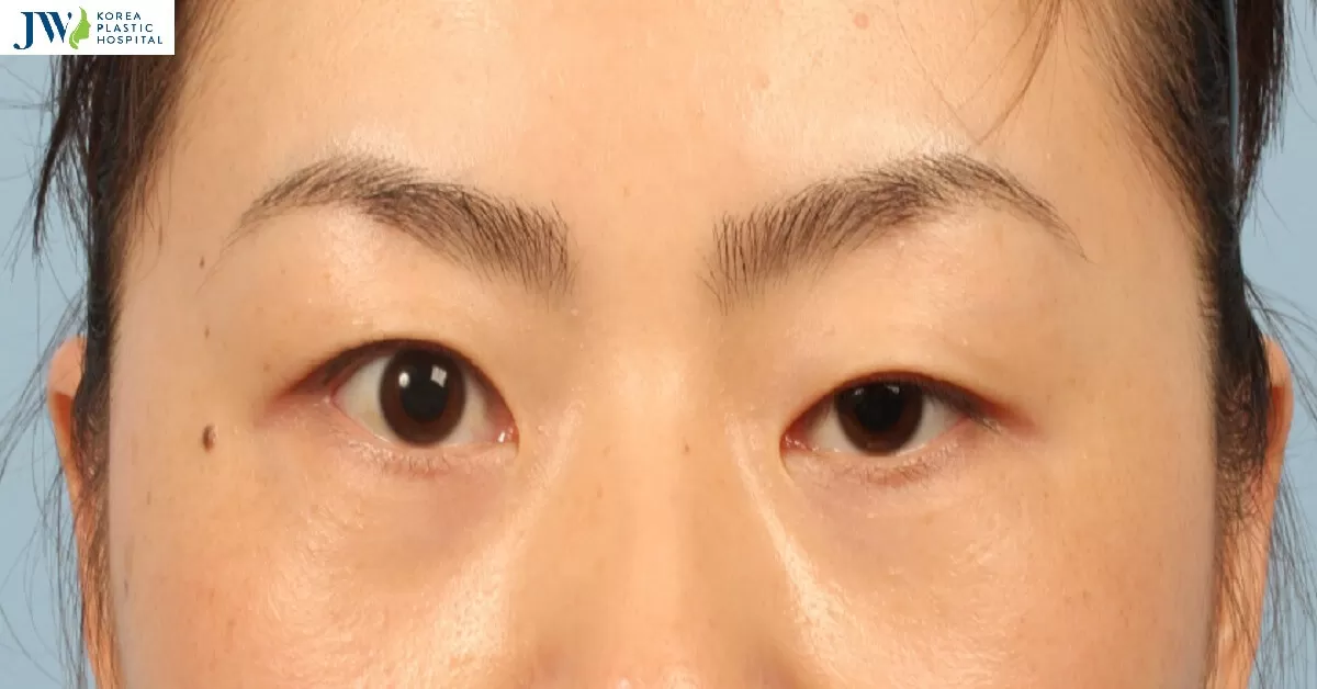 Mắt bị sụp mí sau khi ngủ dậy thì phải giải quyết như thế nào?