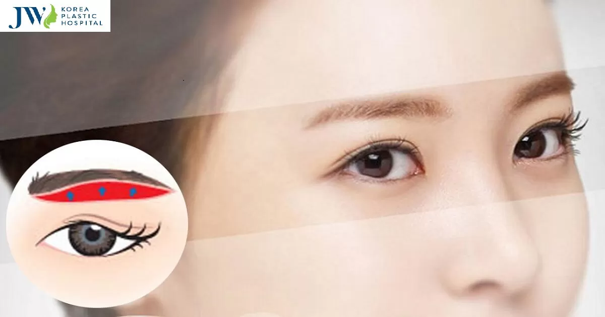 Nâng cung mày bao lâu thì hết sẹo? Bí quyết chăm sóc sau phẫu thuật