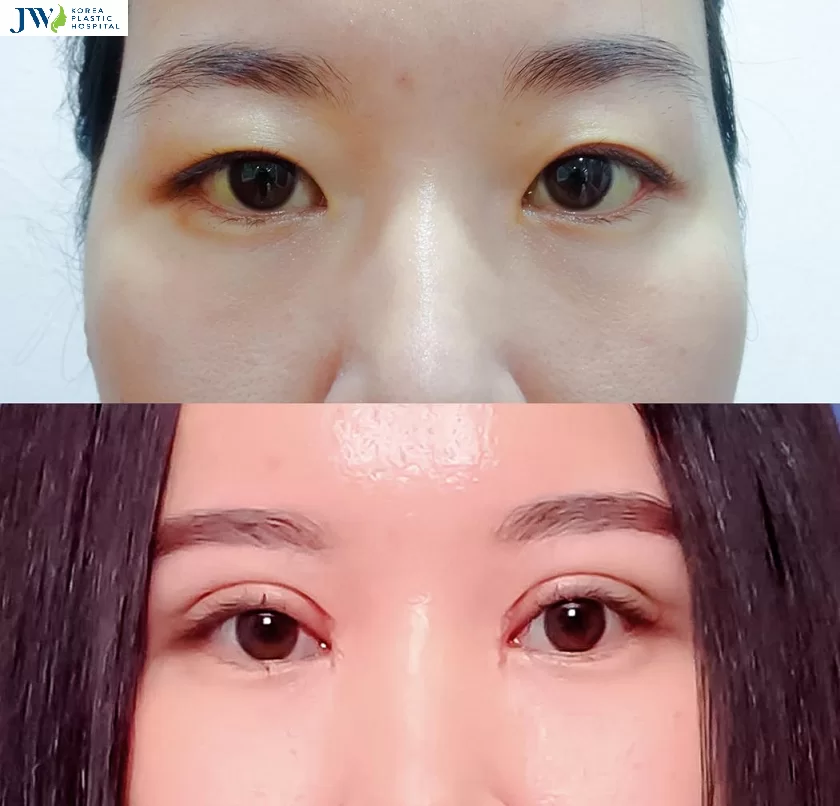 nhấn mí mắt 