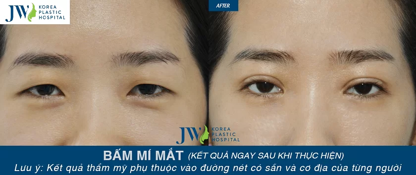 Nhấn mí và cắt mí ở đâu tốt