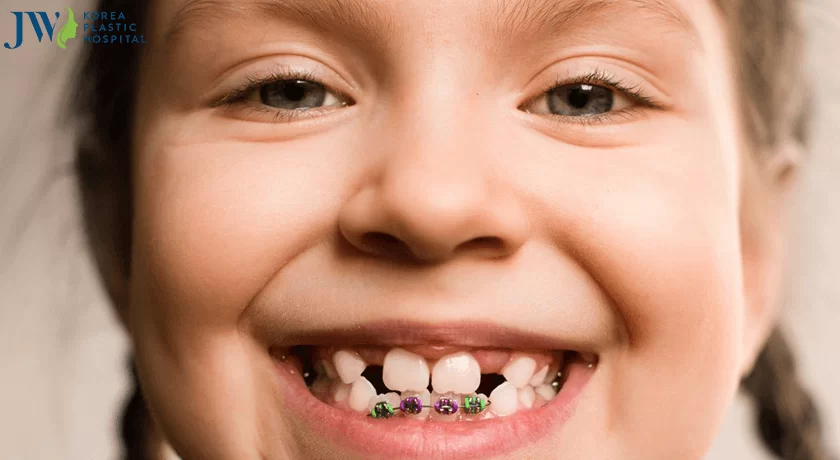 Niềng răng từ sớm 1