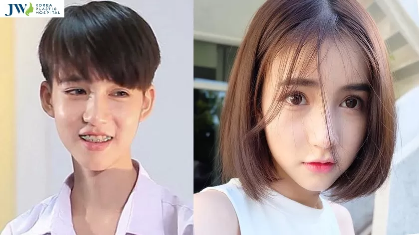 sau khi phẫu thuật chuyển giới