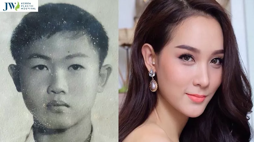 sau khi phẫu thuật chuyển giới