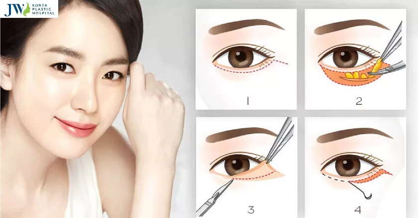 Sụp mí bẩm sinh