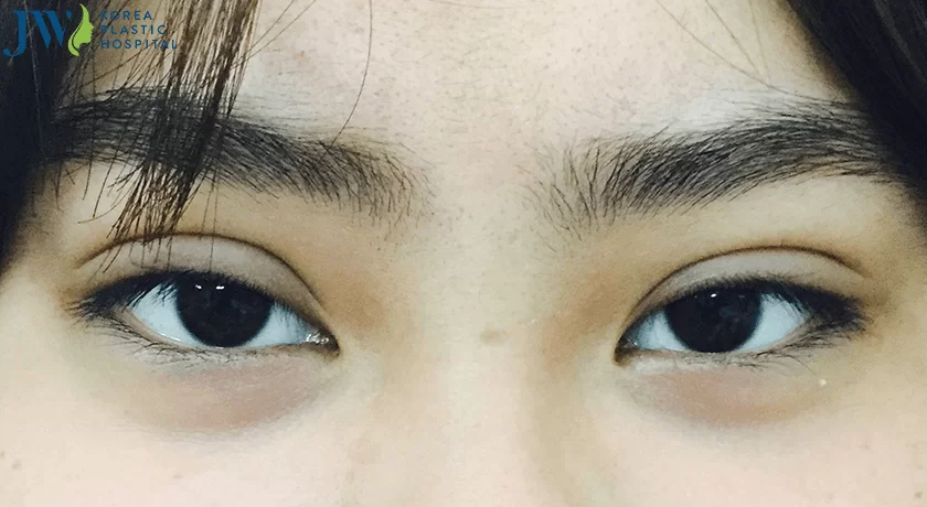sụp mi mắt 