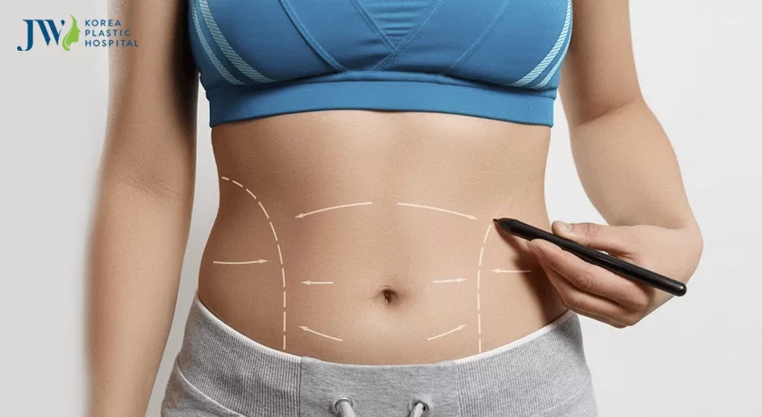 Các loại hình phẫu thuật tạo thành bụng