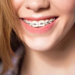 Niềng răng mắc cài kim loại