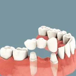 Răng sứ tháo lắp