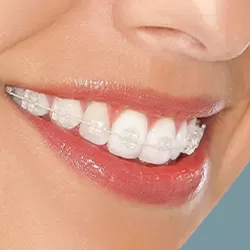 Niềng răng mắc cài sứ Nano