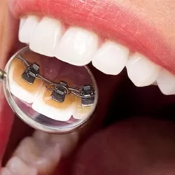 Niềng răng mắc cài mặt trong