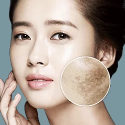 Điều trị bớt - Xóa xăm