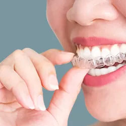 Niềng răng trong suốt AI ( Invisalign -Mỹ)