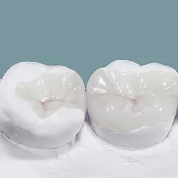 Inlay-Onlay Zirconia