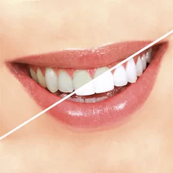 Tẩy trắng răng<br>Led Bleaching