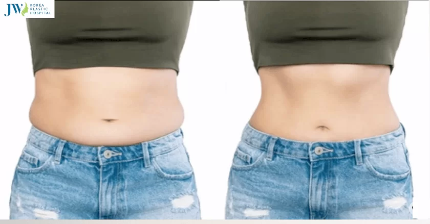 Hút mỡ bụng là gì?