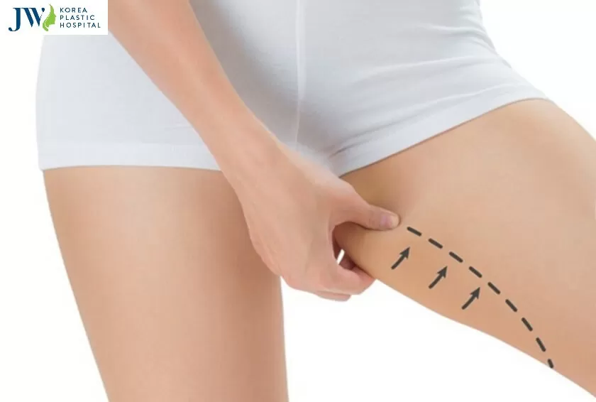 Có nên chọn nơi hút mỡ đùi giá thấp không?