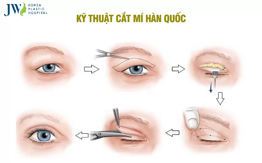 Khắc phục mí lọt bằng phương pháp phẫu thuật