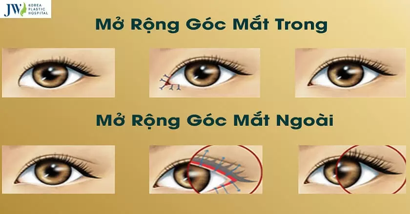 mở góc mắt trong ngoài 