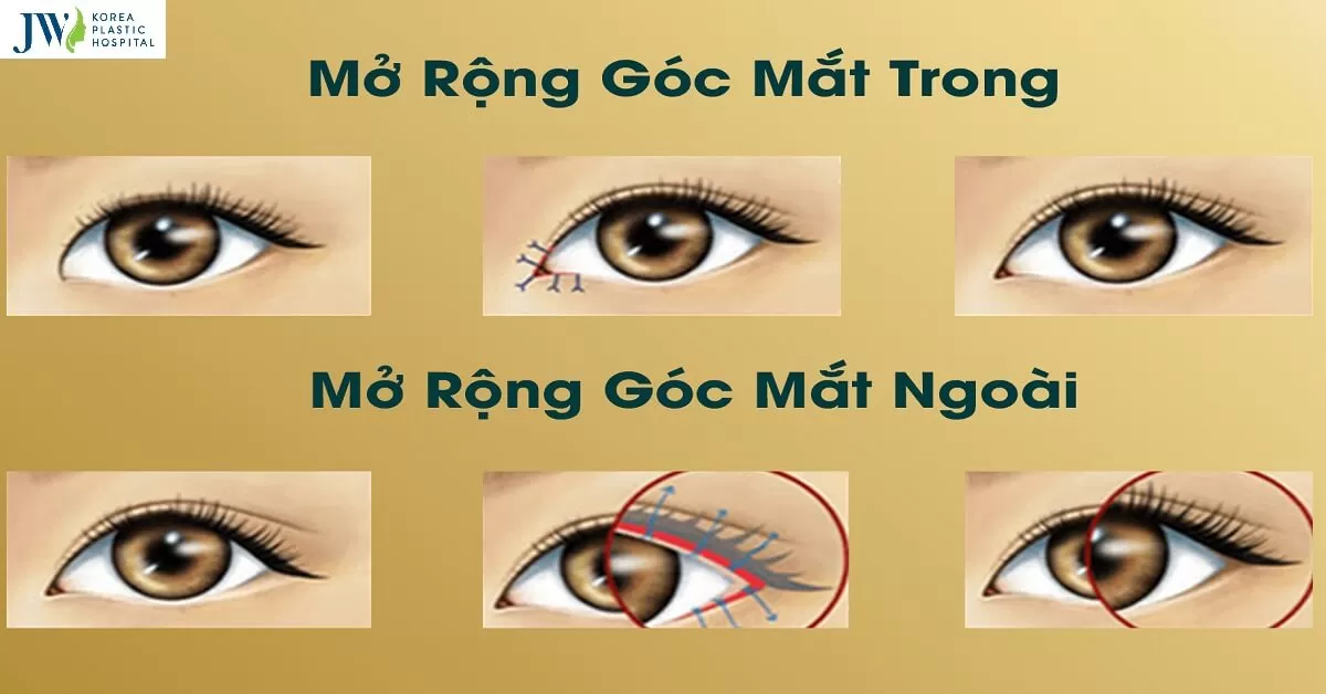 Mở góc mắt trong ngoài có bị sẹo xấu không?