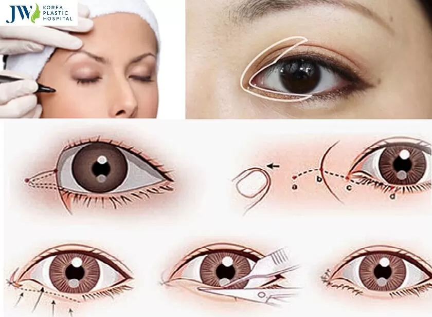 mở góc mắt trong ngoài 