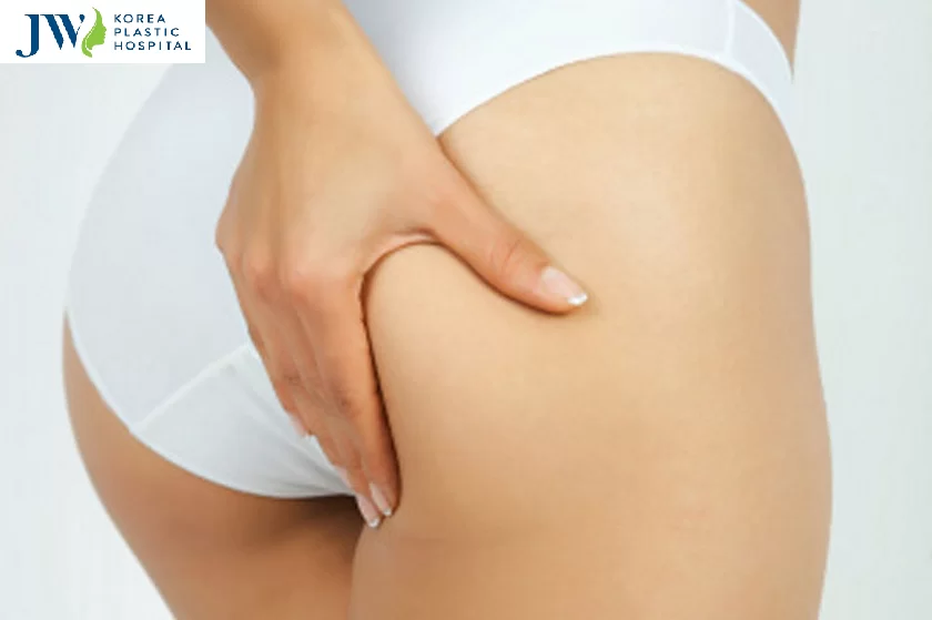 Mông xệ là như thế nào?Mông xệ là như thế nào?