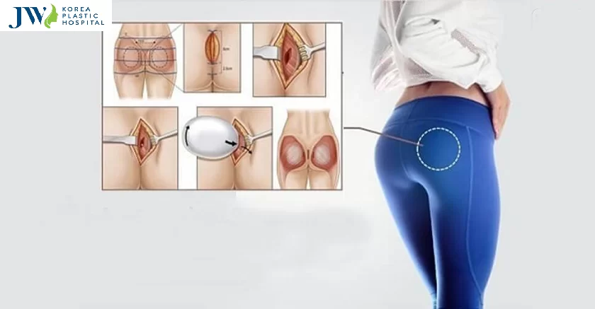 Nâng mông bao lâu thì ngồi được?