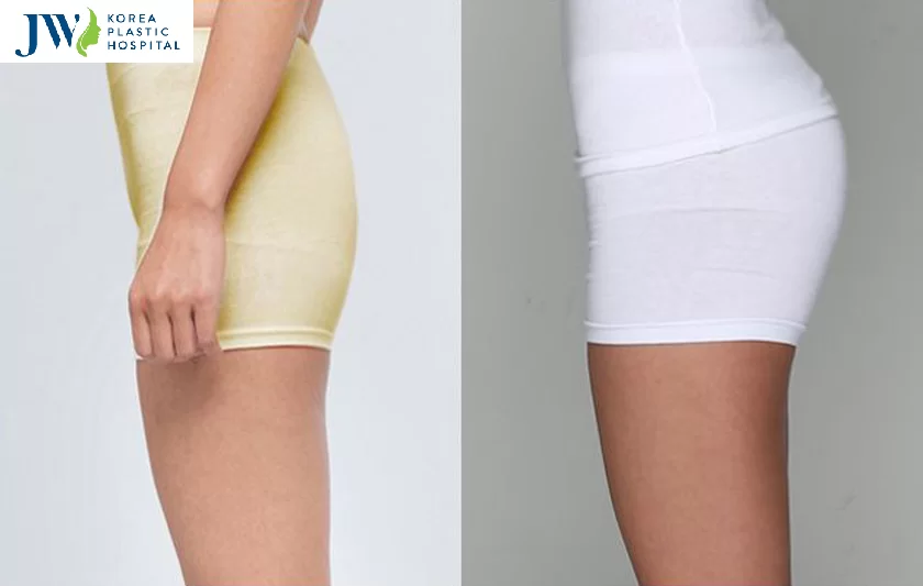 Bệnh viện JW - Địa chỉ nâng mông uy tín