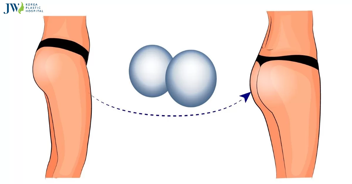 Nâng mông giá bao nhiêu tiền? Cập nhật giá nâng mông mới nhất