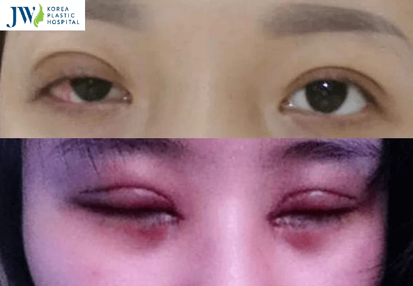 Nguyên nhân gây nhấn mí bị hỏng, lệch