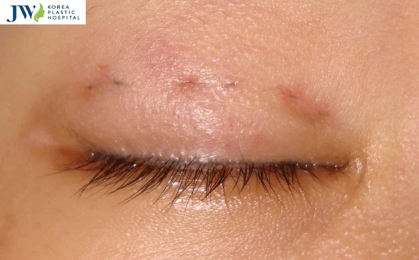 Biểu hiện của nhấn mí mắt bị hỏng, lệch