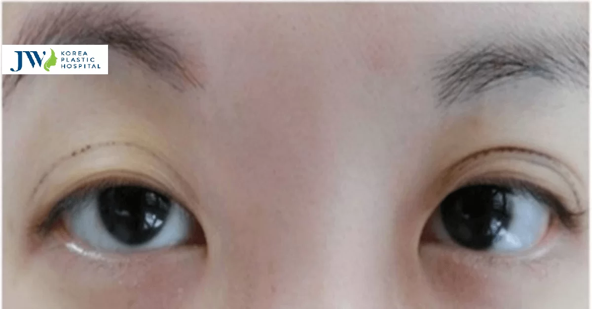 Nhấn mí bị Hỏng, Lệch: Nguyên nhân, cách khách phục nhấn mĩ hỏng